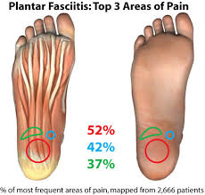 plantar fasciitis.jpg